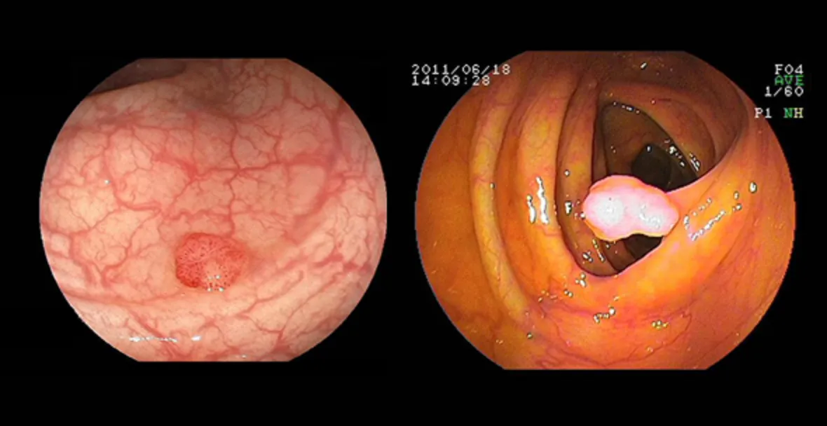 大腸内視鏡の撮影画像