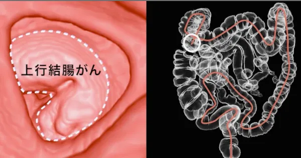 バーチャル内視鏡の案内画像