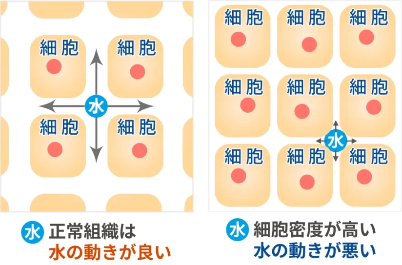 細胞密度と水分子の動きを比較したイメージ図