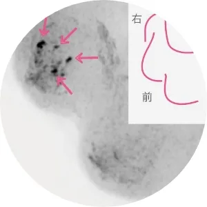 乳がん検査の画像例