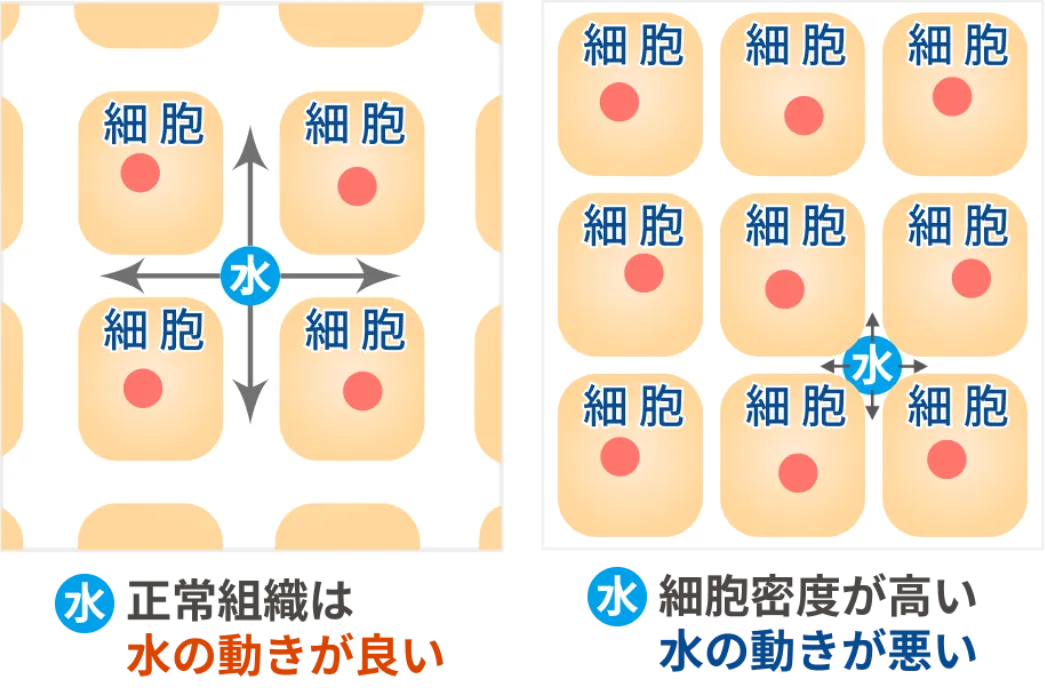 正常組織とがん組織における細胞間の水の動きの違いを示す図解