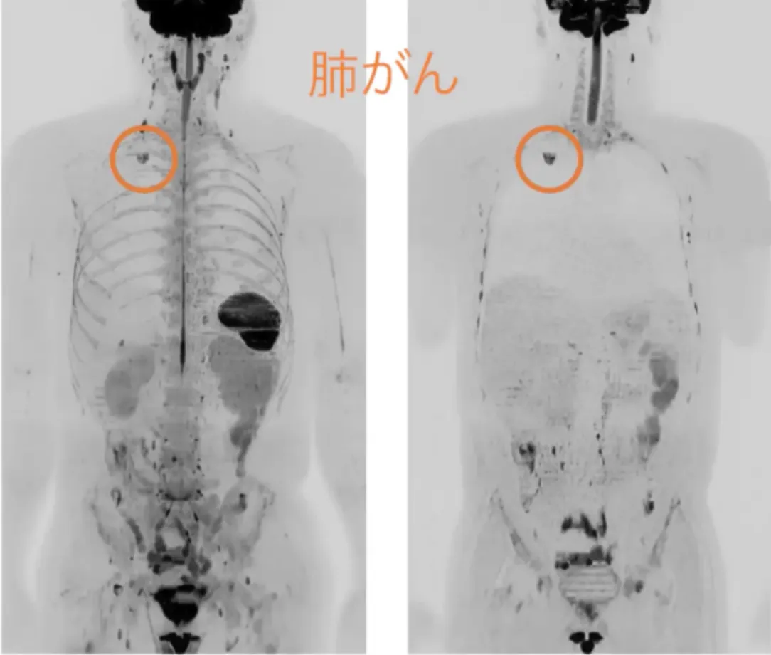 DWIBSによる全身スキャン画像の例（肺がんの検出イメージ）