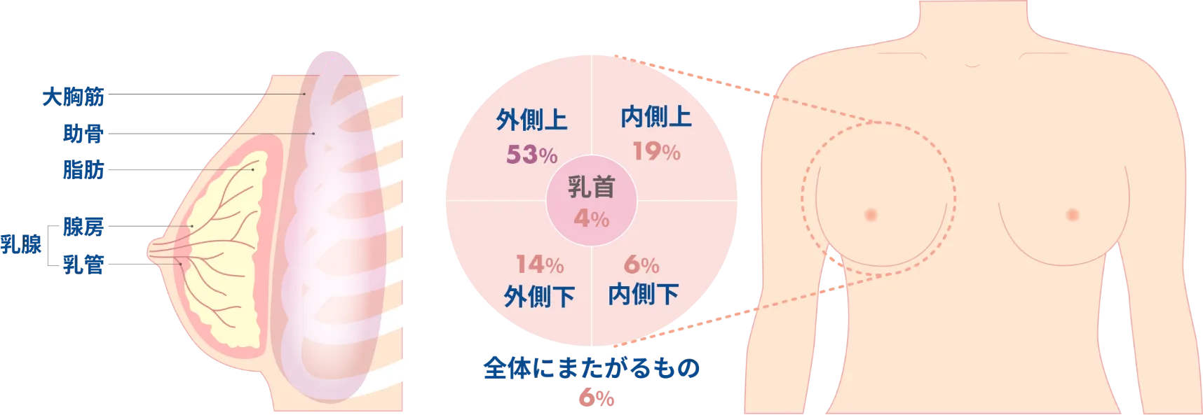 乳がんの説明イメージ