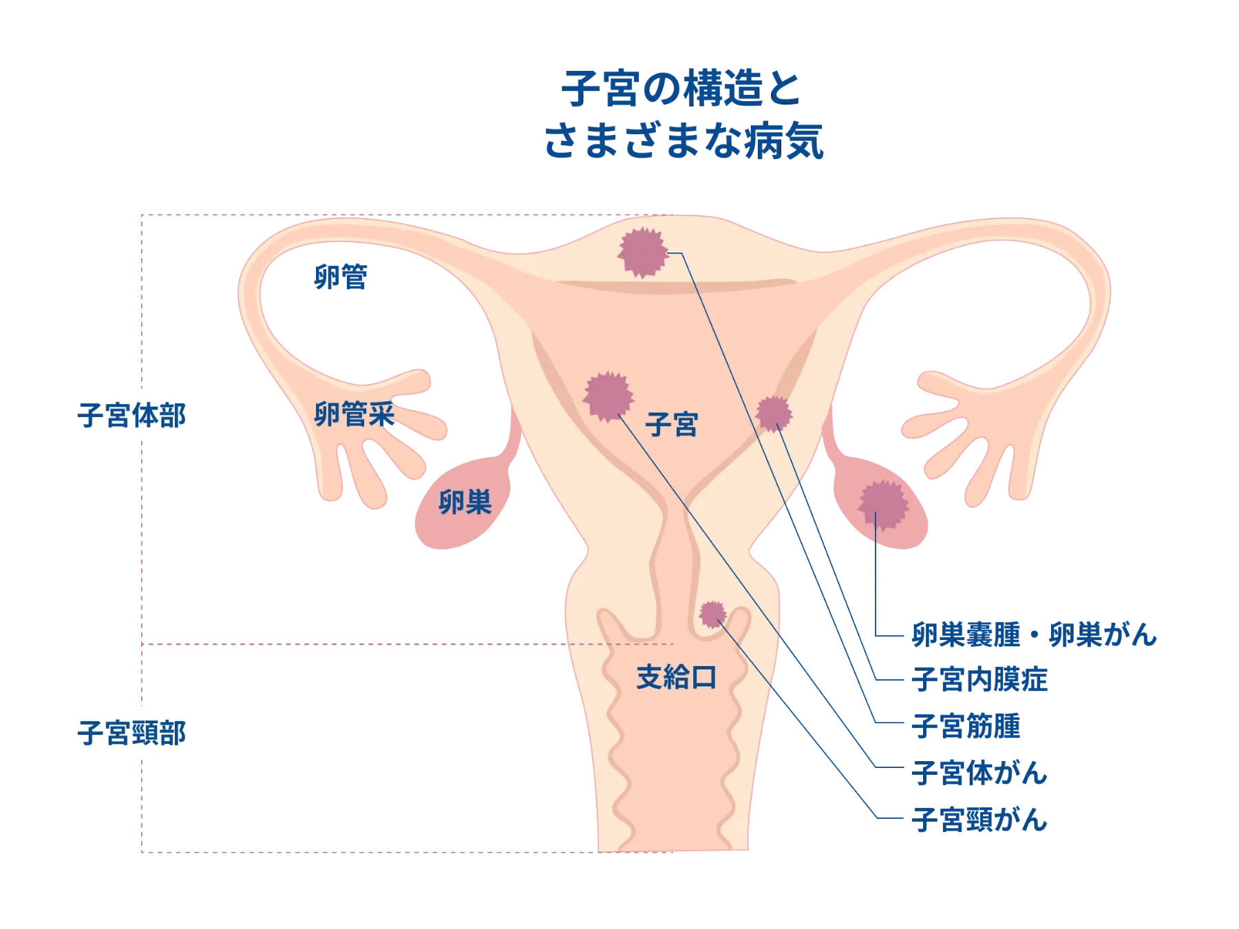 子宮がんと卵巣がんの説明イメージ