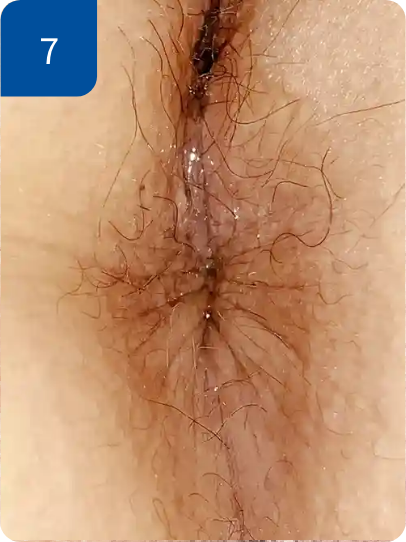 手術後3週間