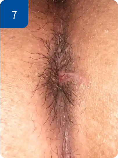 手術後3週間