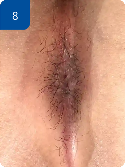 手術後3週間