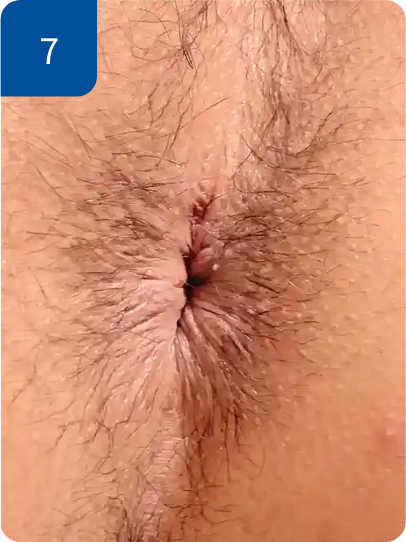 手術後3週間