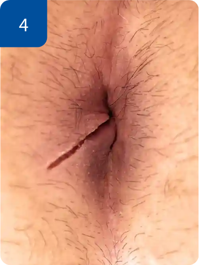 手術直後
