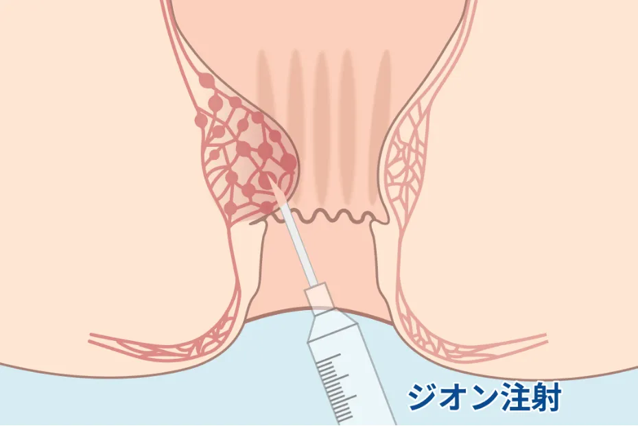 ジオン注射進行