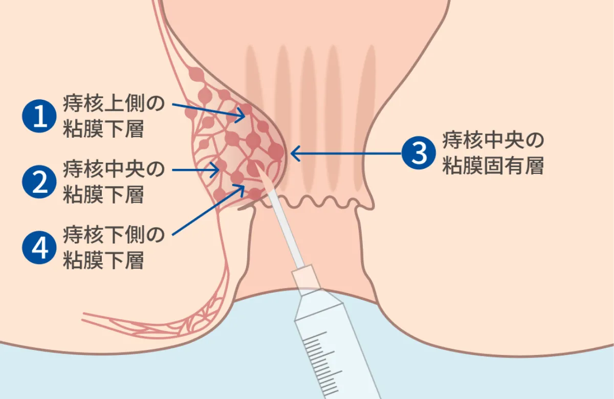ジオン注射の注入