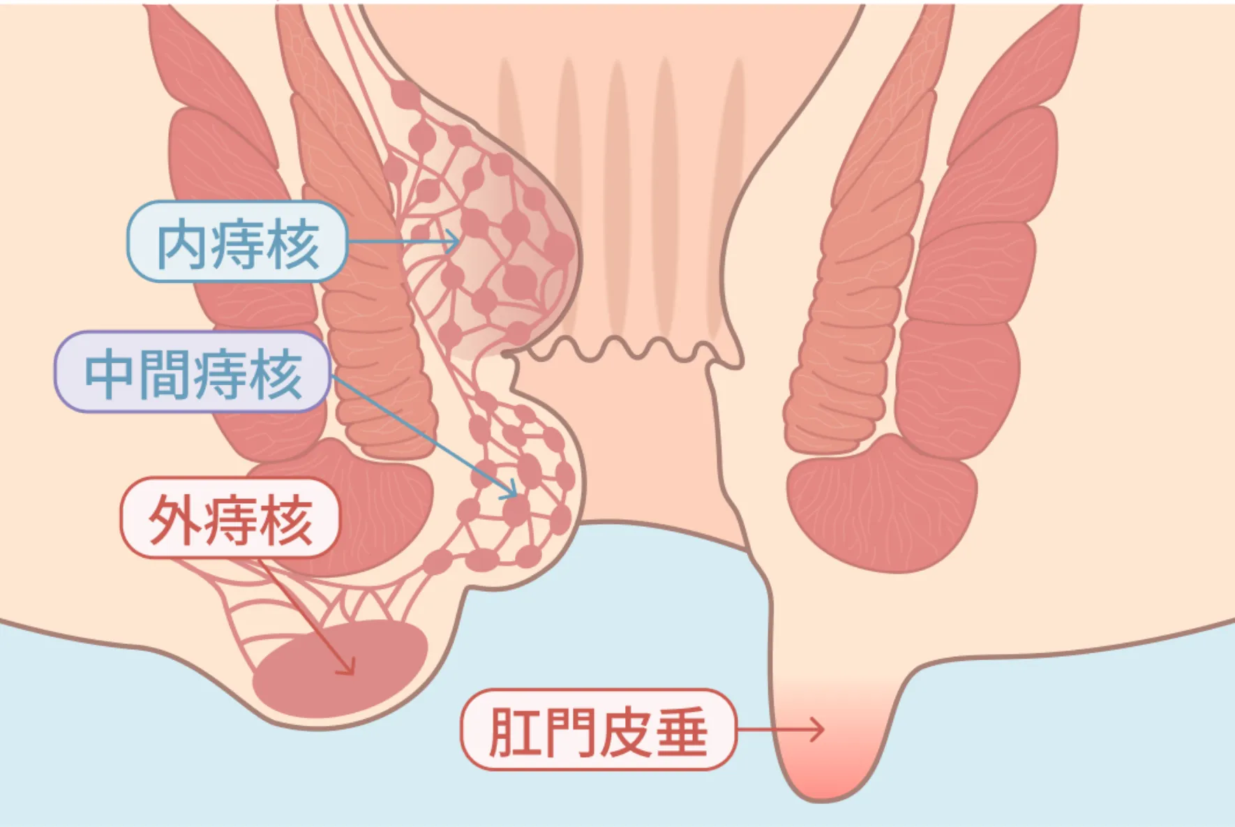 痔核根治手術（いぼ痔・嵌頓痔核）
