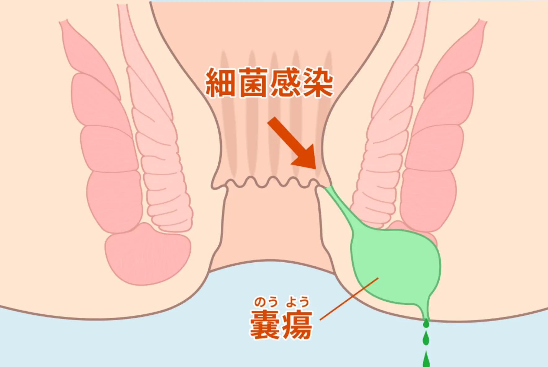 痔瘻根治手術（痔ろう/肛門周囲膿瘍）