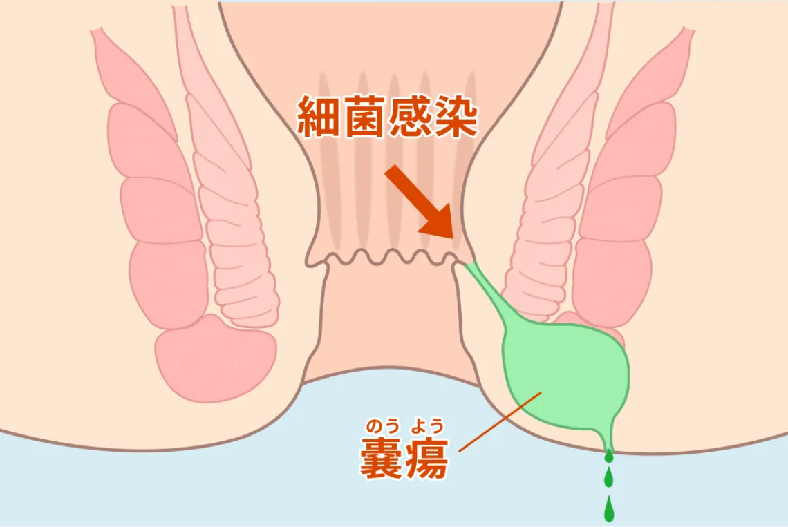 痔ろうの治療 ダブルドレナージ法