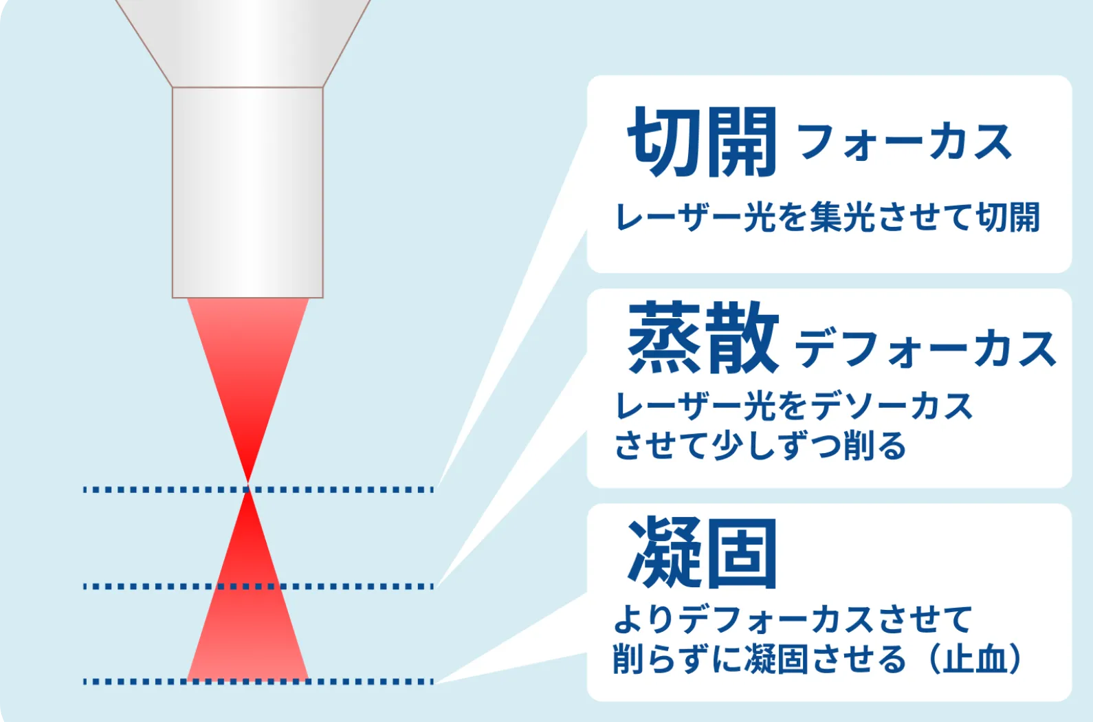 ① CO₂レーザーメスのフォーカスビームとデフォーカスビームの使い分けの知識と手技