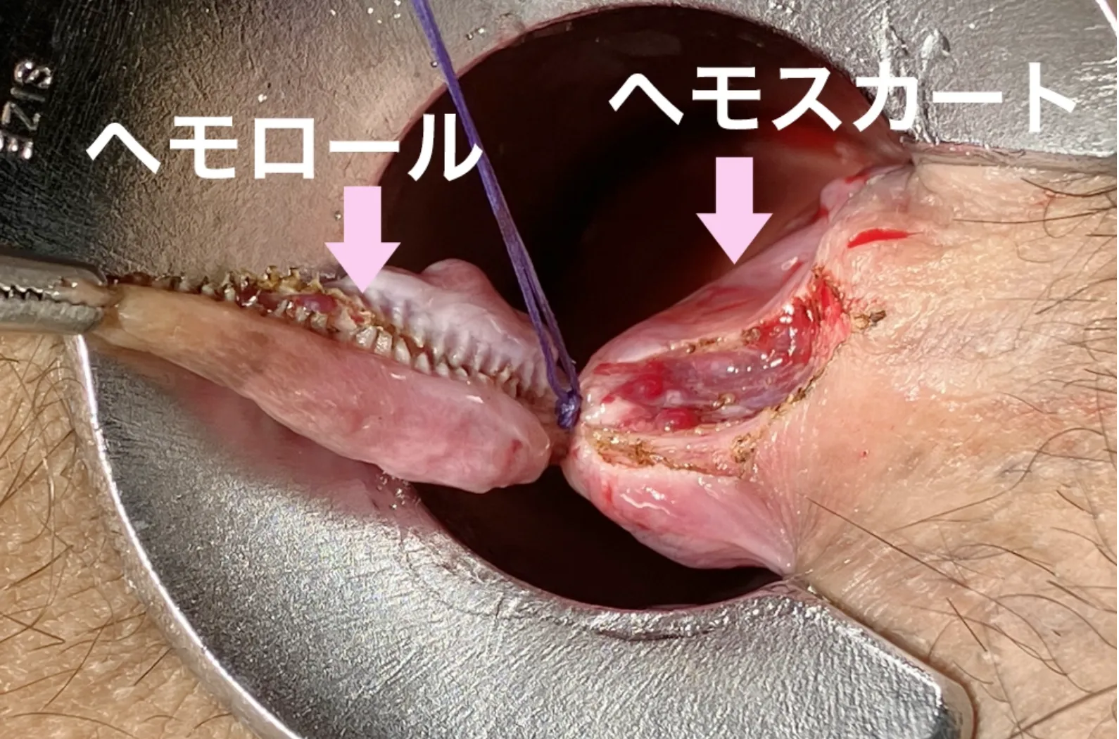 ② 痔核の過剰切除に注意