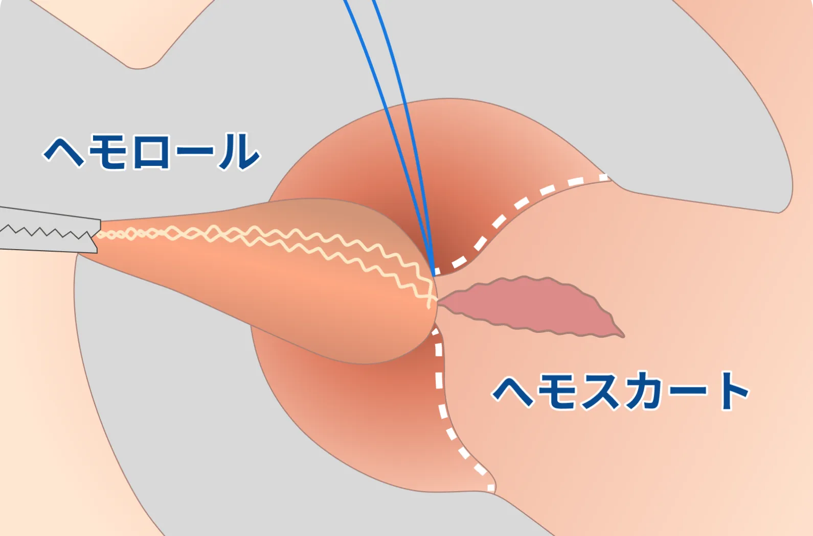② 痔核の過剰切除に注意