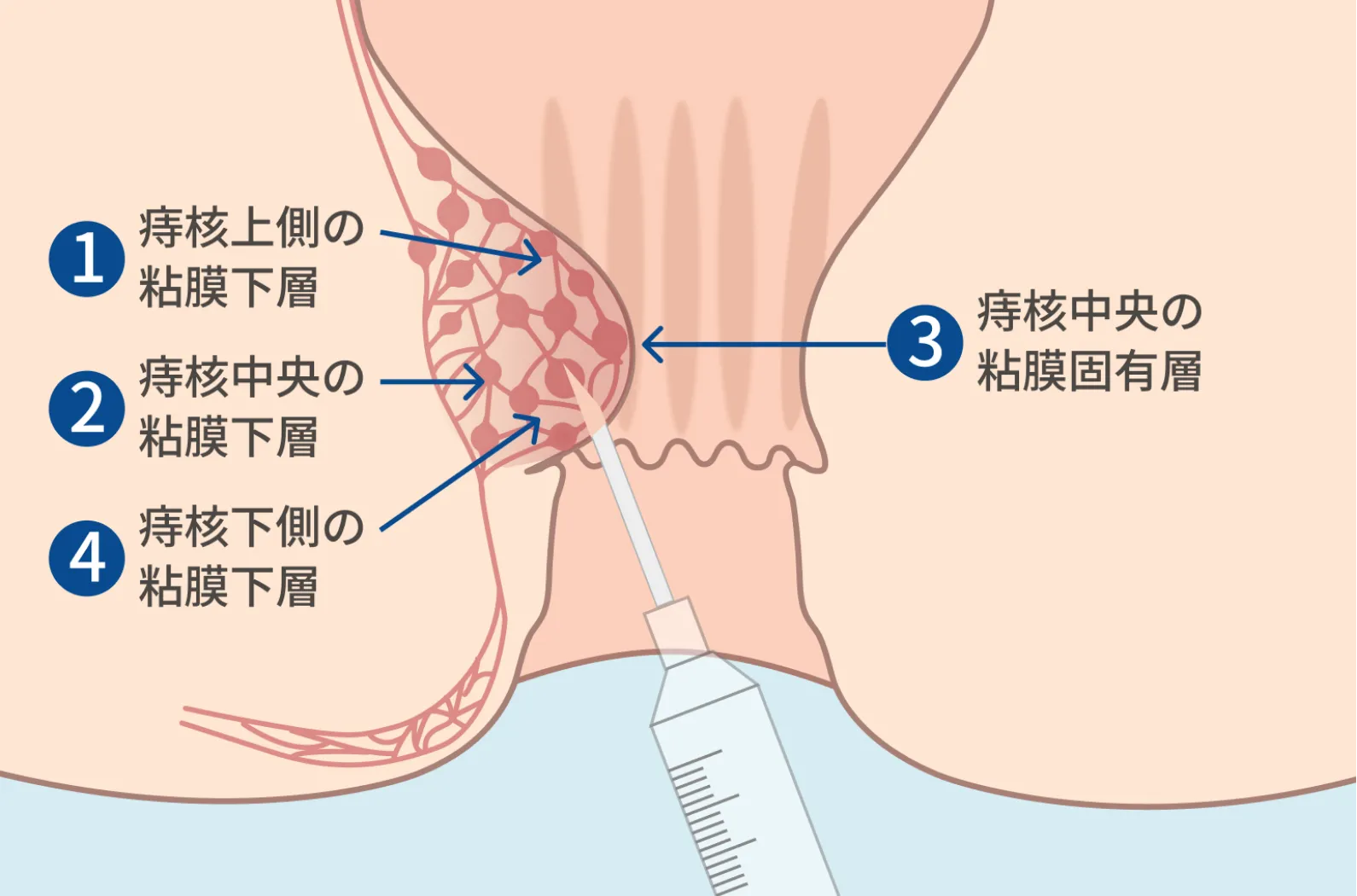 ③ ジオン注射の知識と手技