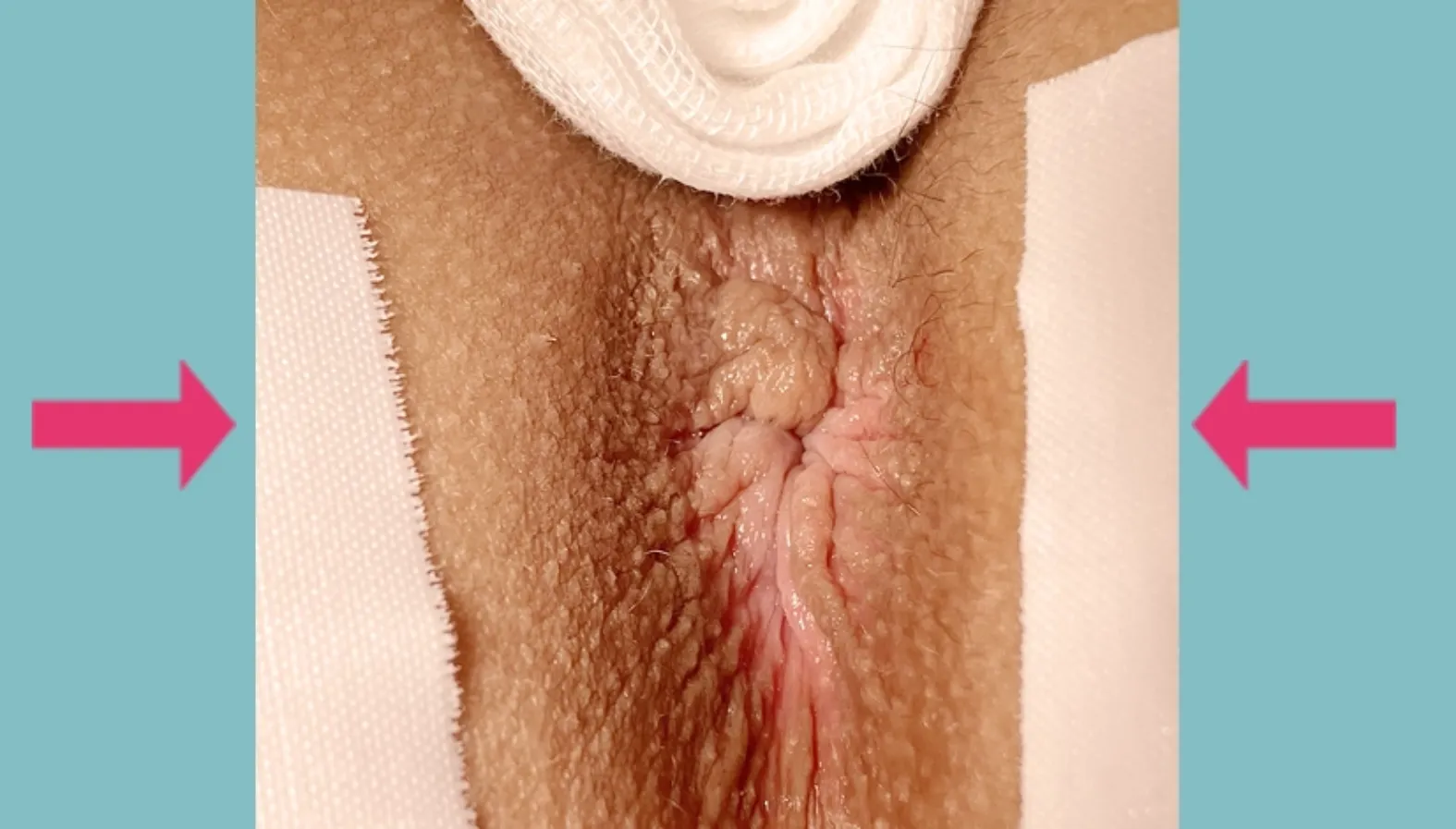 ⑤ 創傷治癒を意識した手術創の形成