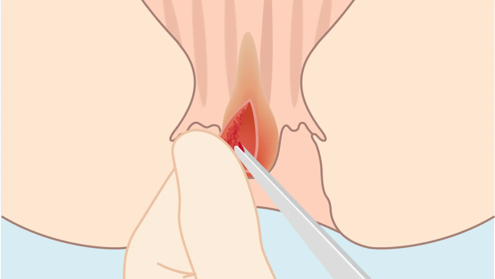 ⑦ 手術創より皮下粘膜剥離（アンダーマイニング）にて痔核郭清（摘出）及び静脈叢の郭清を行う手技の研磨