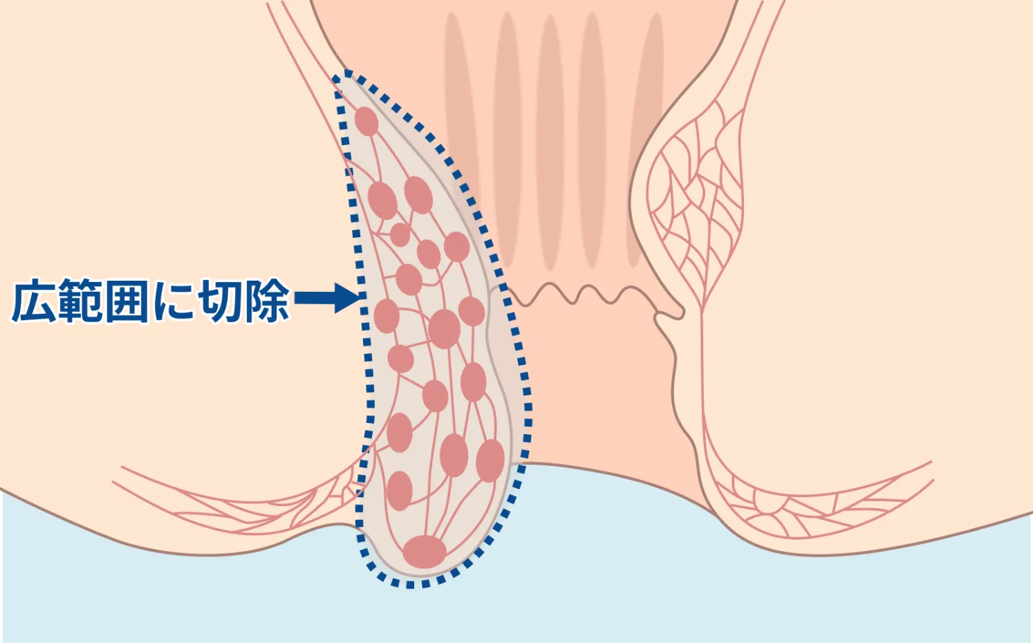結紮切除術（保険診療）