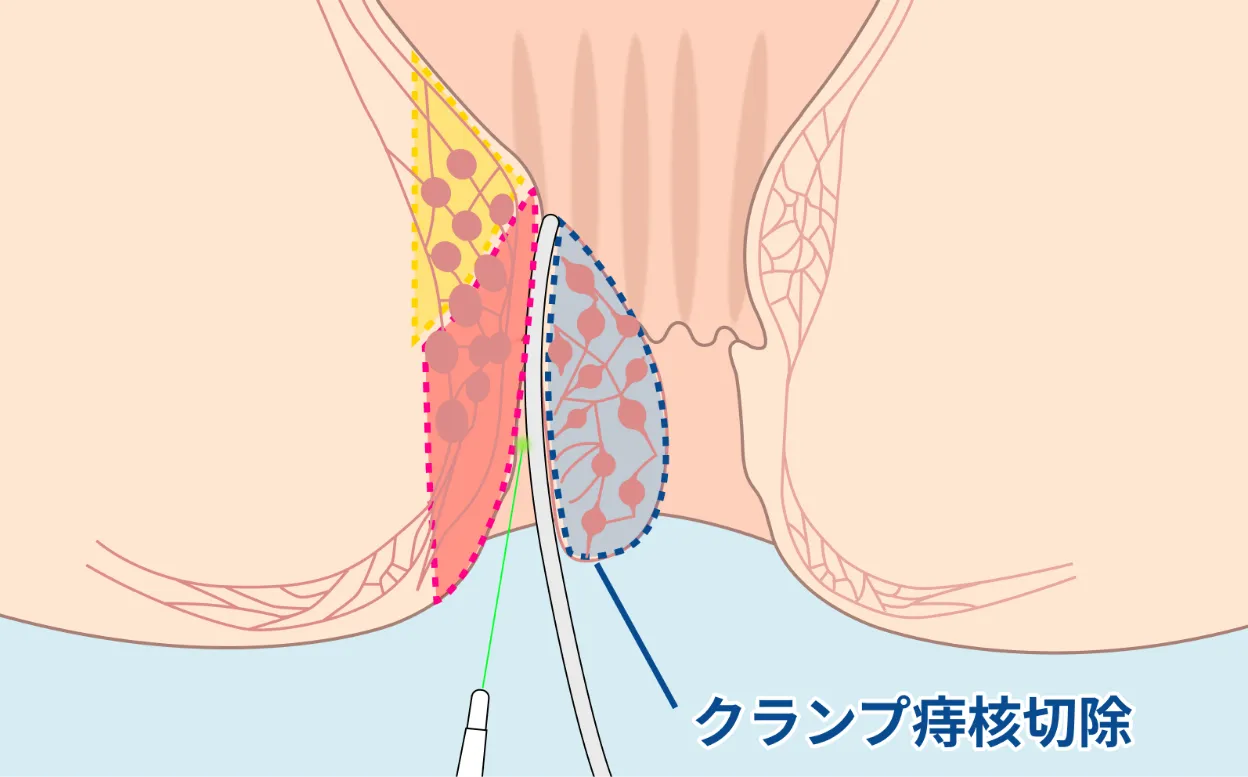 1. 痔核切除（痔核の中心部を除去）