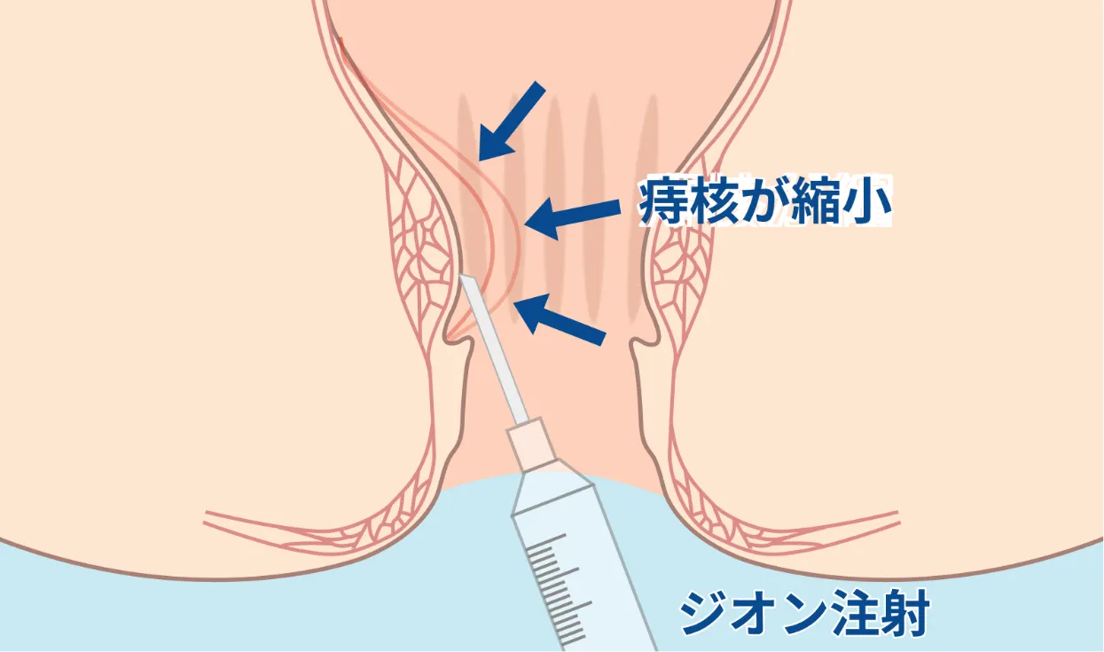 3. ジオン注射（下部直腸の痔核治療）