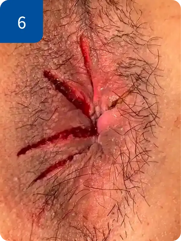 手術直後