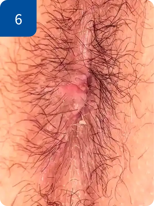 手術後1週間