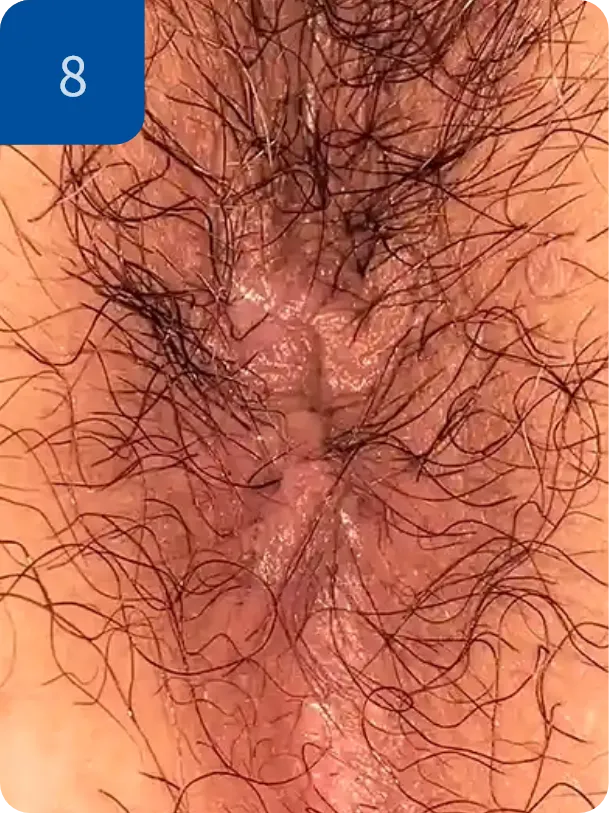 手術後1週間
