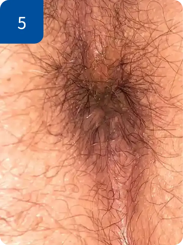 手術後1週間