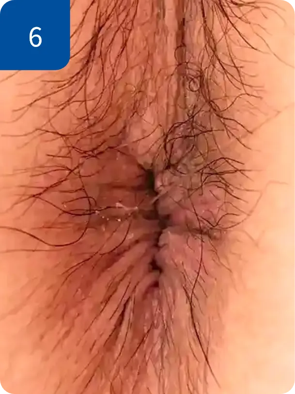 手術後1週間