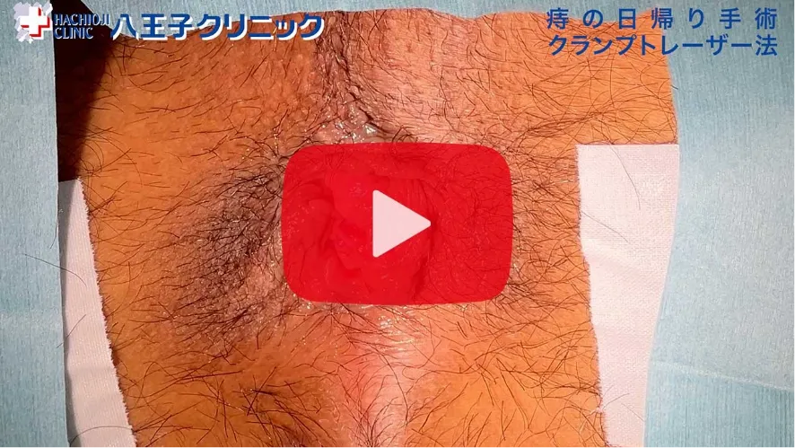 いぼ痔の手術動画 ❶ 【01:04】
