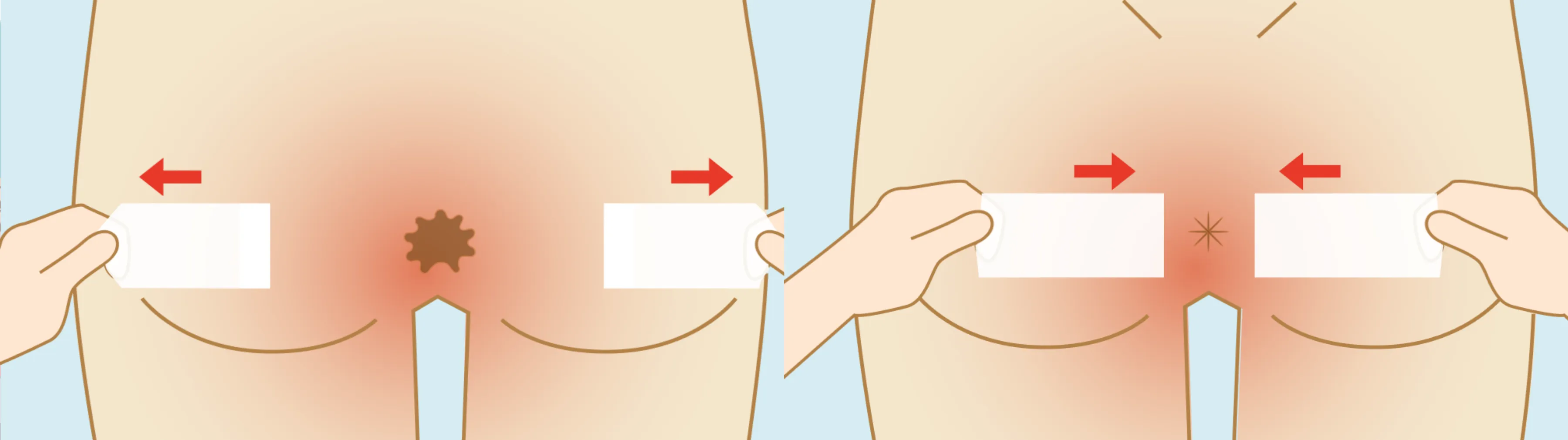 仙骨硬膜腔に麻酔薬を注入