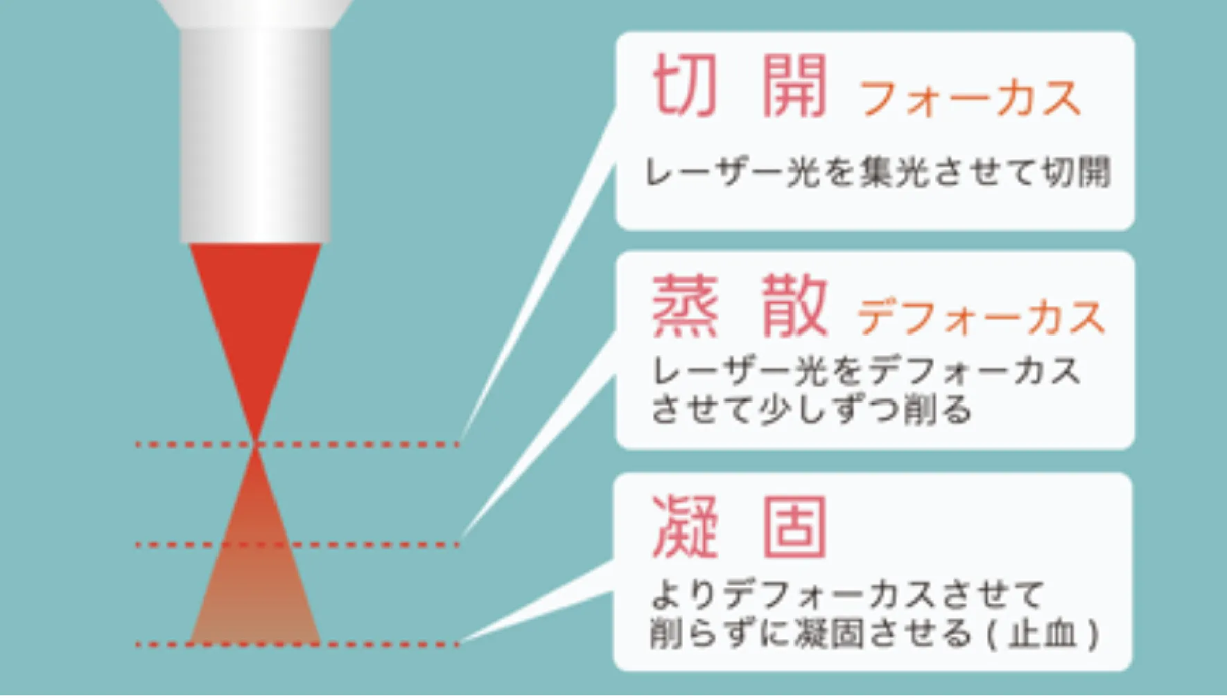 02　複雑な形の病変もきれいに切除