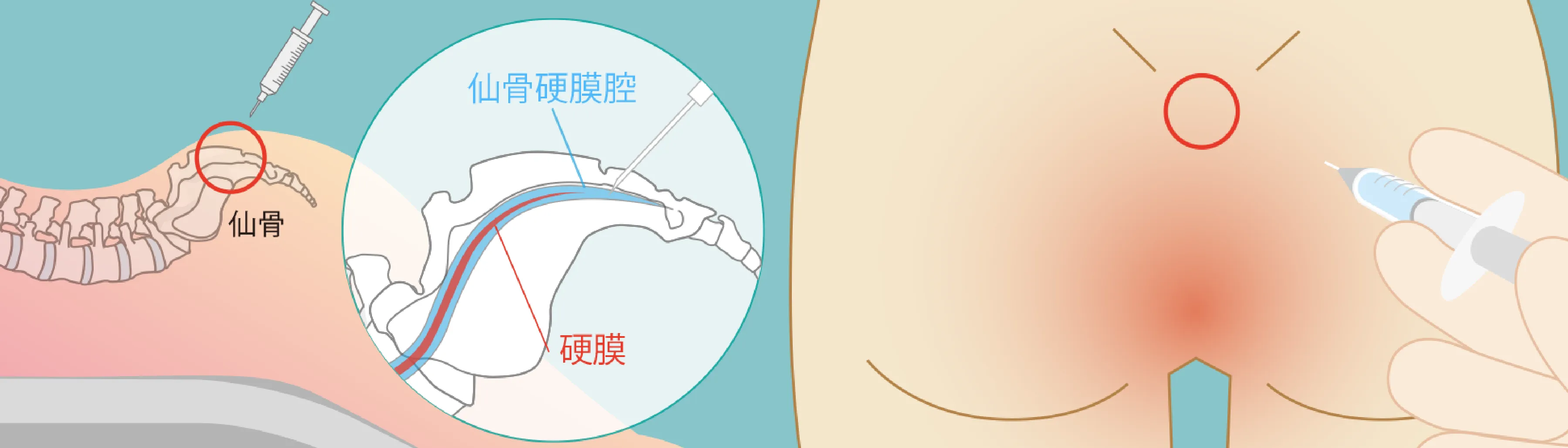 仙骨硬膜腔に麻酔薬を注入
