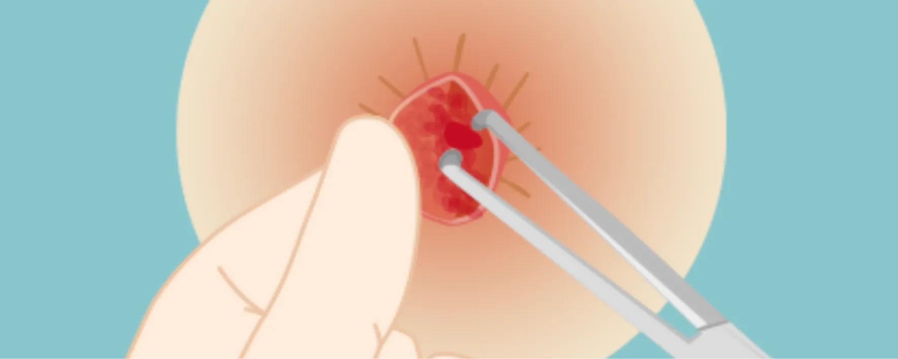 小さな創から皮膚粘膜の下にある痔核を取り除く