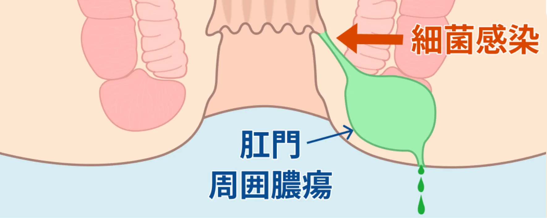 膿瘍形成