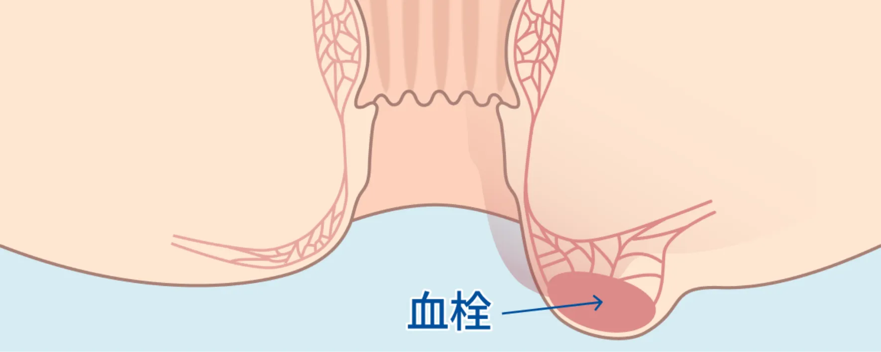 血栓性外痔核