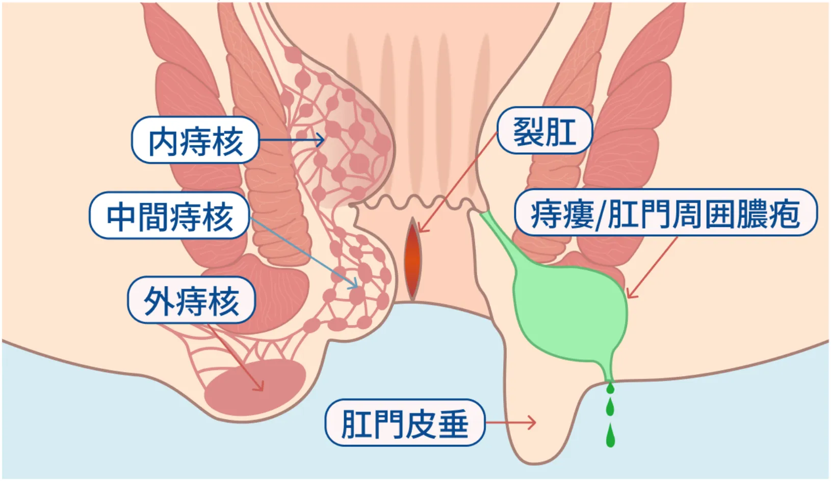 痔の種類