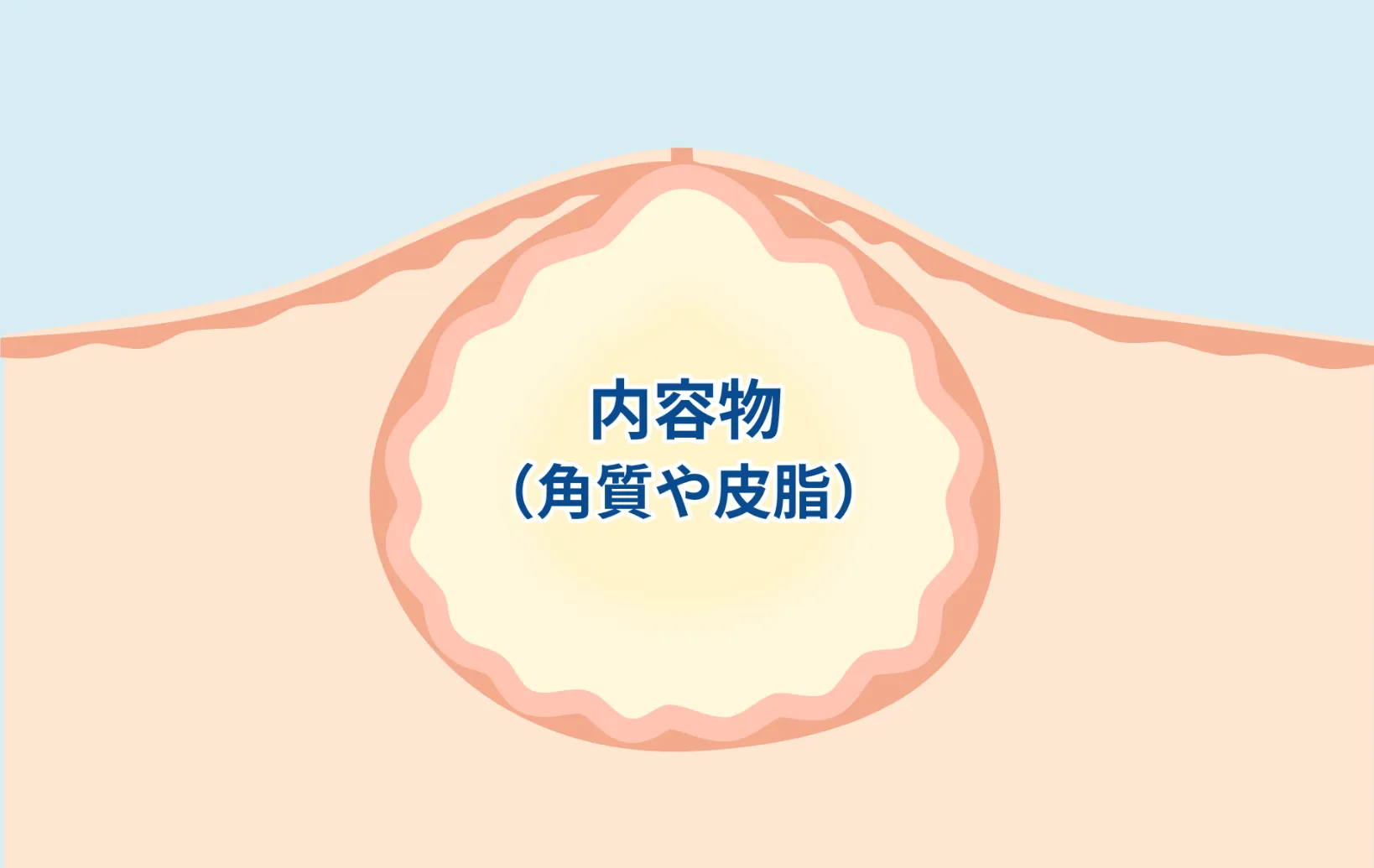 粉瘤とは？
