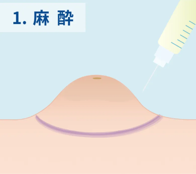麻酔