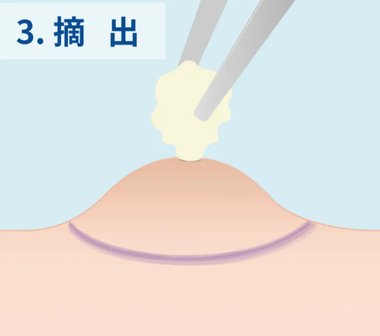 摘出