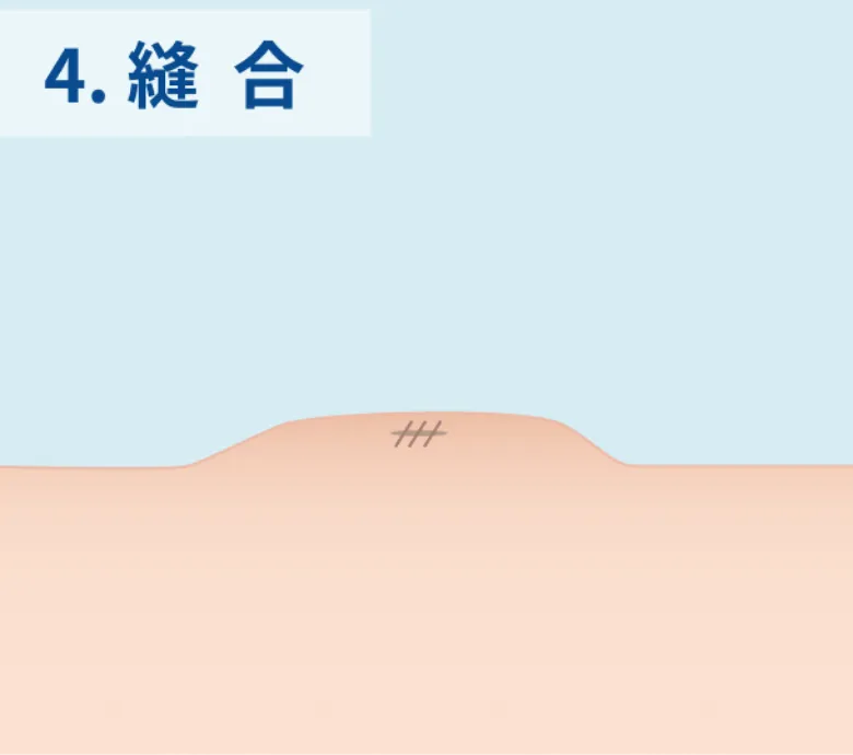 縫合