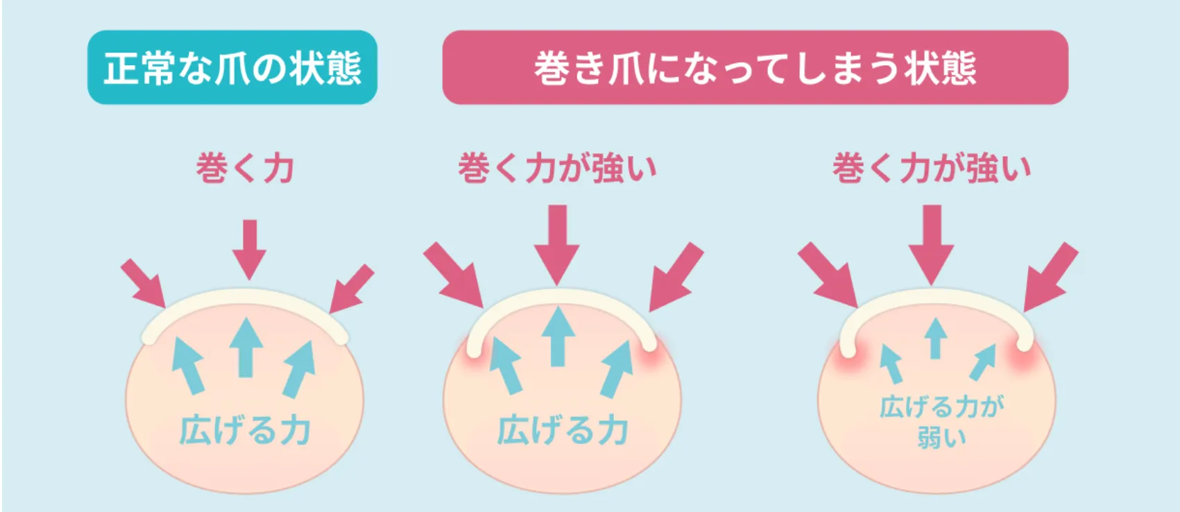 巻き爪の原因