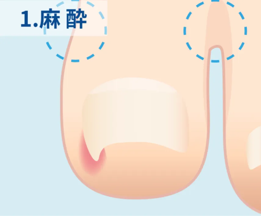 麻酔