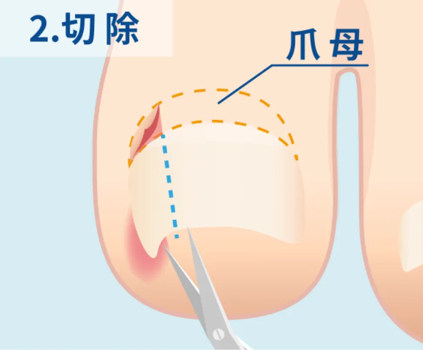 切開