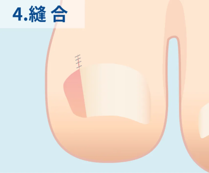 縫合