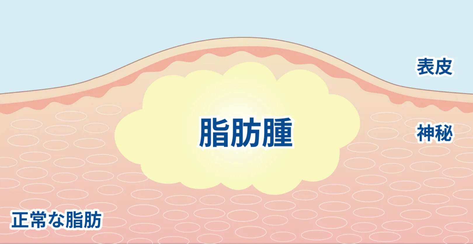 粉瘤とは？