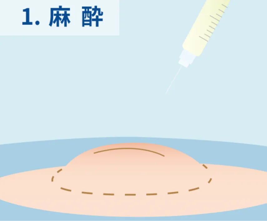 麻酔